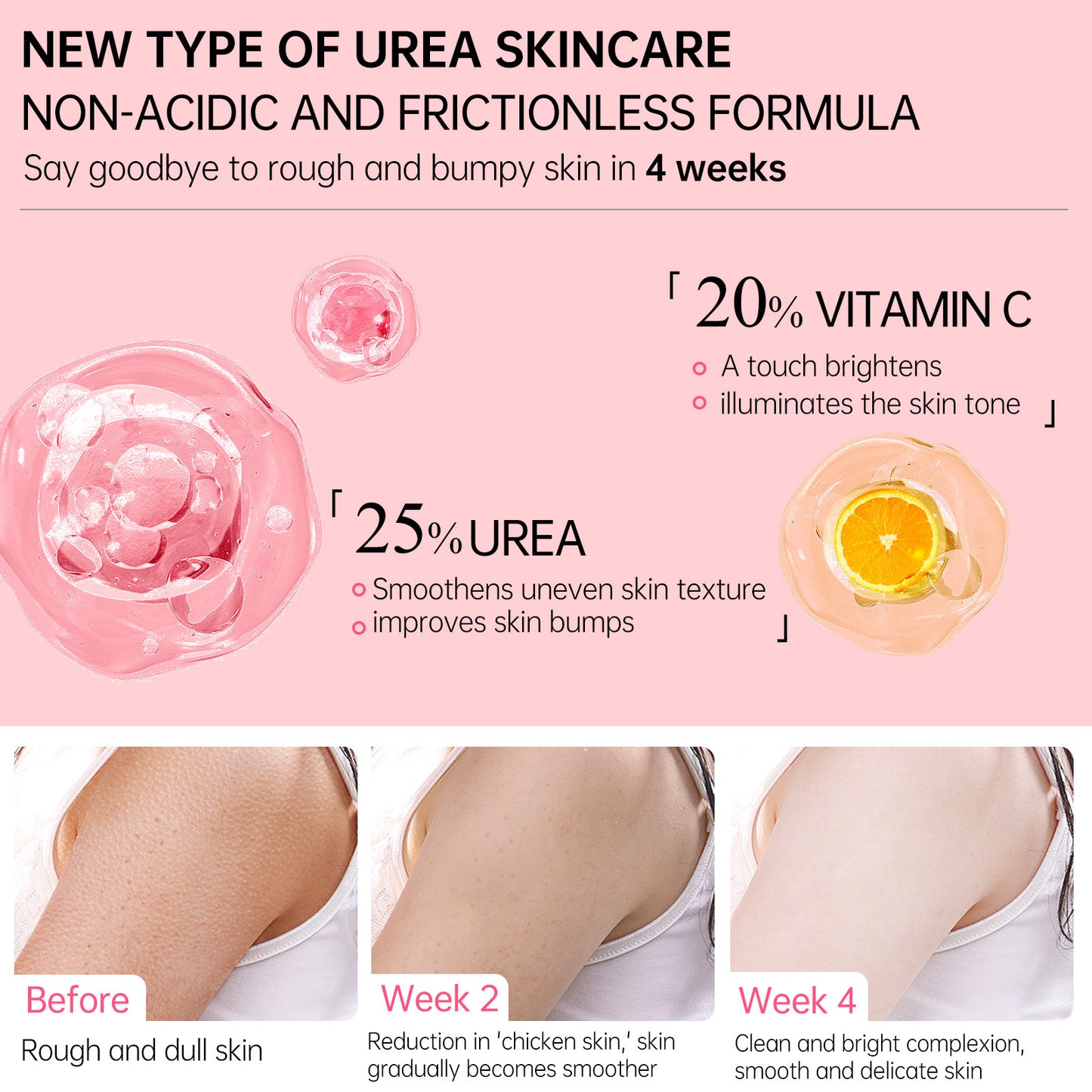 Chicken skin cream for keratosis pilaris urea skincare with vitamin C improves rough skin texture in 4 weeks