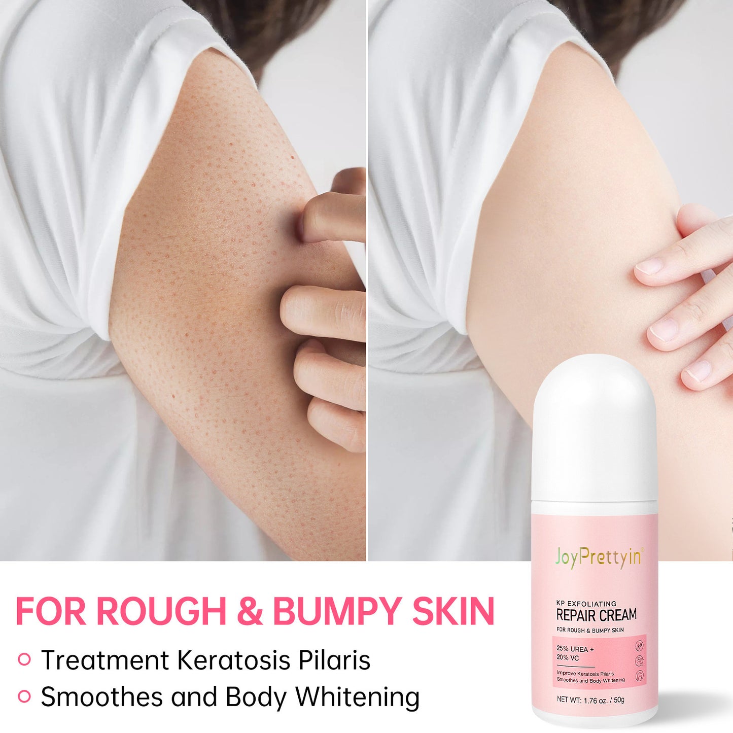 Before and after results using chicken skin cream for keratosis pilaris showing smoother, clearer arm skin
